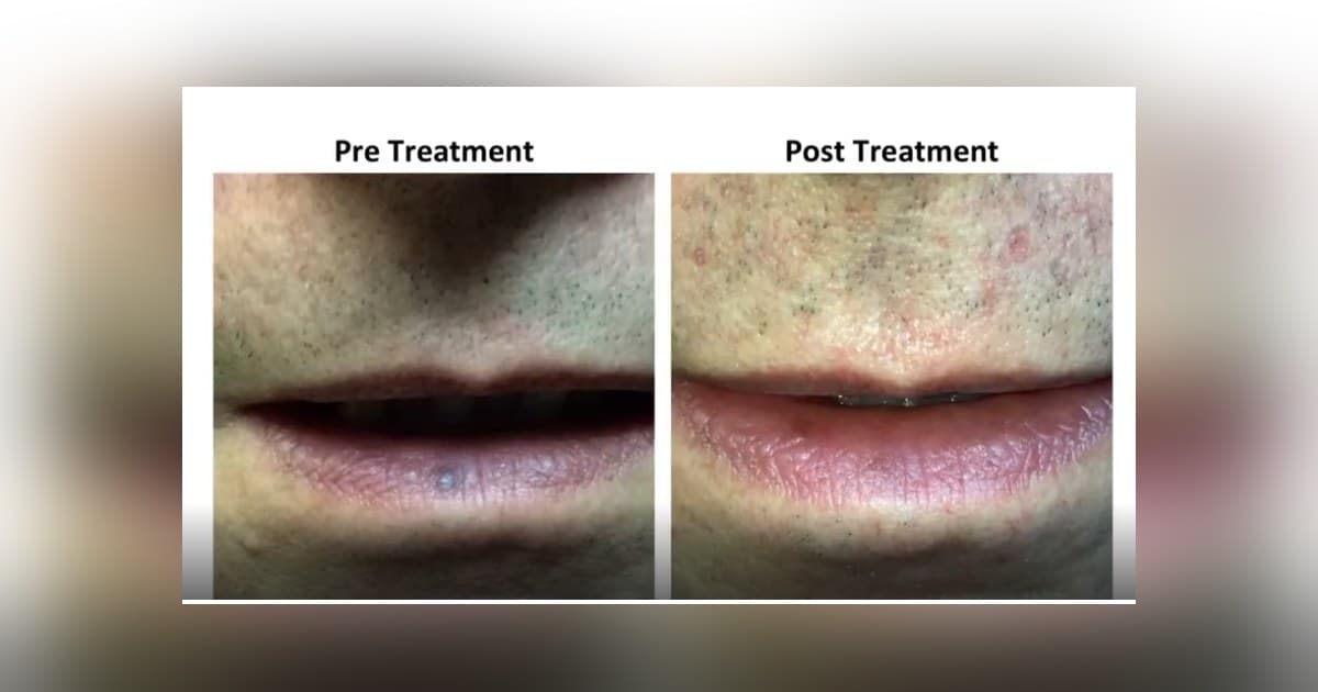 Vascular Surgeon Brings Specialized Expertise to Venous Lake Treatment, Highlighting a Common but Underrecognized Condition